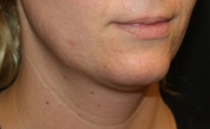 Kybella Before & After Patient #19907