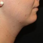 Kybella Before & After Patient #19907