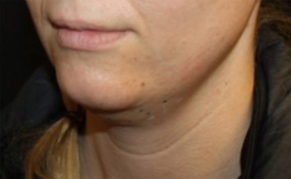 Kybella Before & After Patient #19907