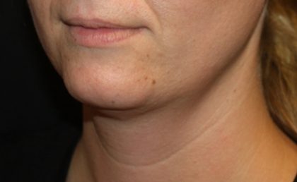 Kybella Before & After Patient #19907