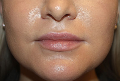 Injectable Fillers Before & After Patient #23257