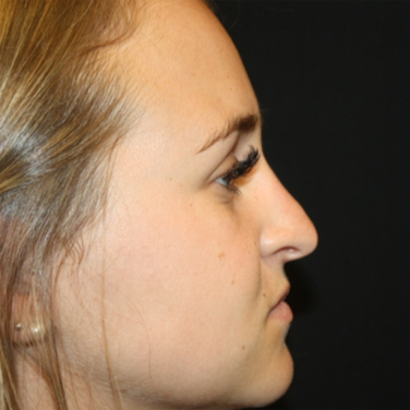 Rhinoplasty Before & After Patient #22324