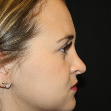 Rhinoplasty Before & After Patient #22324