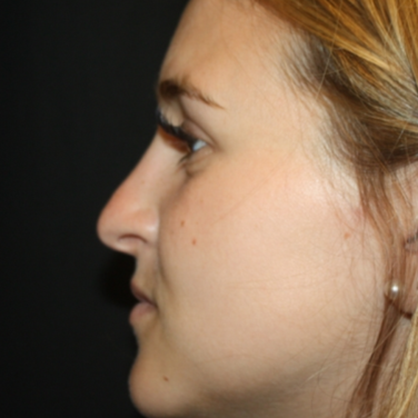 Rhinoplasty Before & After Patient #22324