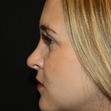 Rhinoplasty Before & After Patient #22324