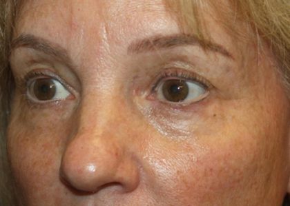 Blepharoplasty Before & After Patient #20131