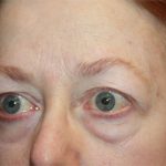 Blepharoplasty and Brow Lift Before & After Patient #20238