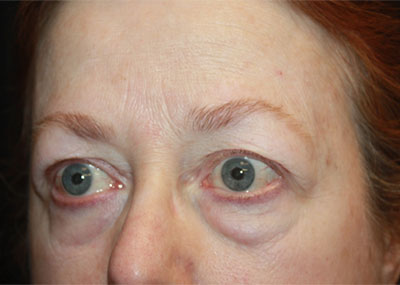 Blepharoplasty and Brow Lift Before & After Patient #20238