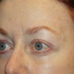 Blepharoplasty and Brow Lift Before & After Patient #20238