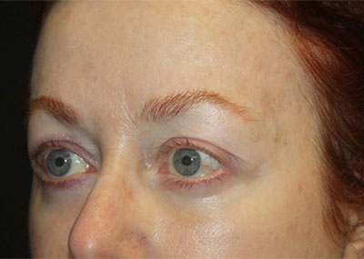 Blepharoplasty and Brow Lift Before & After Patient #20238