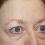 Blepharoplasty and Brow Lift Before & After Patient #20238