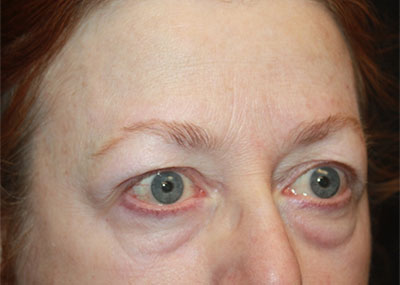 Blepharoplasty and Brow Lift Before & After Patient #20238