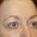 Blepharoplasty and Brow Lift Before & After Patient #20238