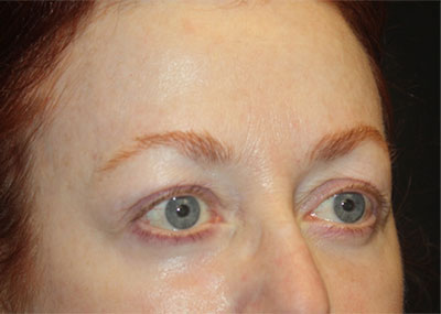 Blepharoplasty and Brow Lift Before & After Patient #20238