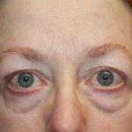 Blepharoplasty and Brow Lift Before & After Patient #20238