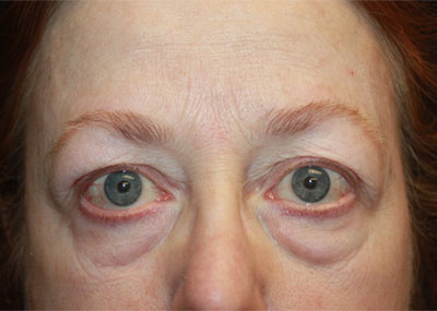 Blepharoplasty and Brow Lift Before & After Patient #20238