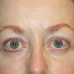 Blepharoplasty and Brow Lift Before & After Patient #20238