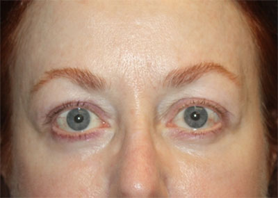 Blepharoplasty and Brow Lift Before & After Patient #20238