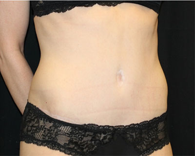Tummy Tuck Before & After Patient #19845