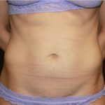 Tummy Tuck Before & After Patient #19845