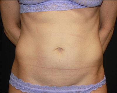 Tummy Tuck Before & After Patient #19845