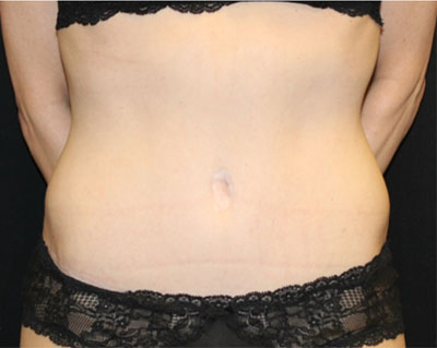 Tummy Tuck Before & After Patient #19845