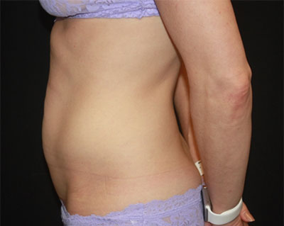 Tummy Tuck Before & After Patient #19845