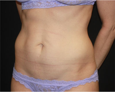 Tummy Tuck Before & After Patient #19845