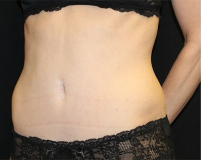 Tummy Tuck Before & After Patient #19845