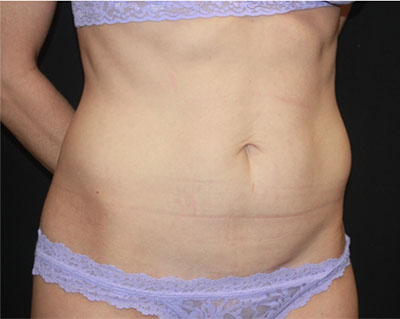 Tummy Tuck Before & After Patient #19845