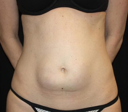 Tummy Tuck Before & After Patient #22275