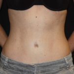 Tummy Tuck Before & After Patient #22275