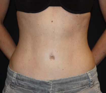 Tummy Tuck Before & After Patient #22275