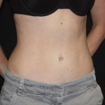 Tummy Tuck Before & After Patient #22275