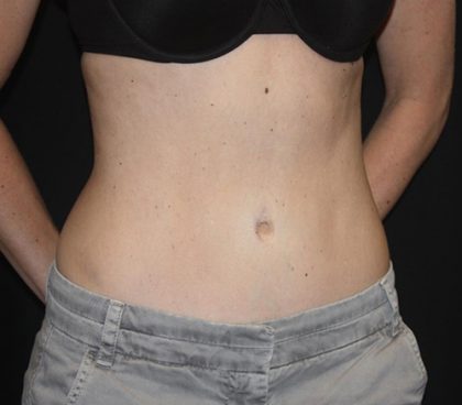 Tummy Tuck Before & After Patient #22275