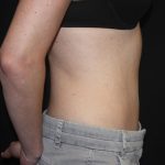 Tummy Tuck Before & After Patient #22275