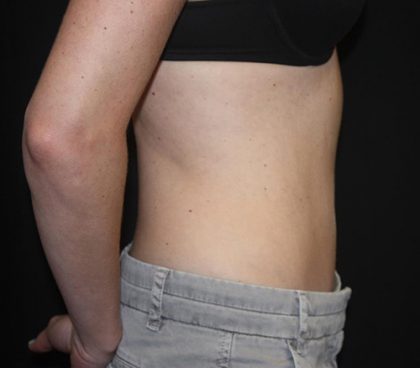 Tummy Tuck Before & After Patient #22275