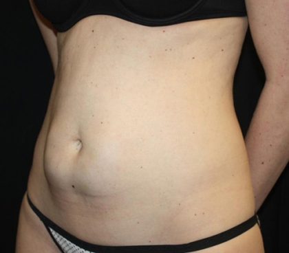 Tummy Tuck Before & After Patient #22275