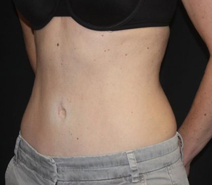 Tummy Tuck Before & After Patient #22275