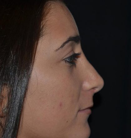 Rhinoplasty Before & After Patient #21793