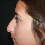 Rhinoplasty Before & After Patient #21793