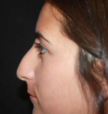 Rhinoplasty Before & After Patient #21793