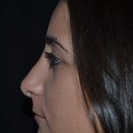 Rhinoplasty Before & After Patient #21793