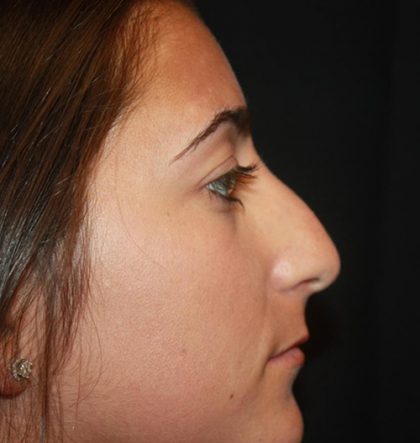 Rhinoplasty Before & After Patient #21793