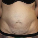 Tummy Tuck Before & After Patient #19867