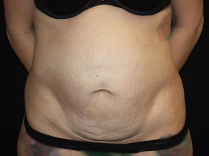 Tummy Tuck Before & After Patient #19867
