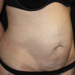 Tummy Tuck Before & After Patient #19867