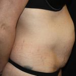 Tummy Tuck Before & After Patient #19867