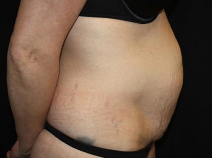 Tummy Tuck Before & After Patient #19867