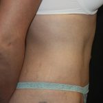 Tummy Tuck Before & After Patient #19867